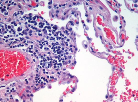 Image of haematoxylin and eosin (H&E) stained section of lung tissue from a patient with end-stage emphysema. CC BY 2.0, https://commons.wikimedia.org/w/index.php?curid=437645.