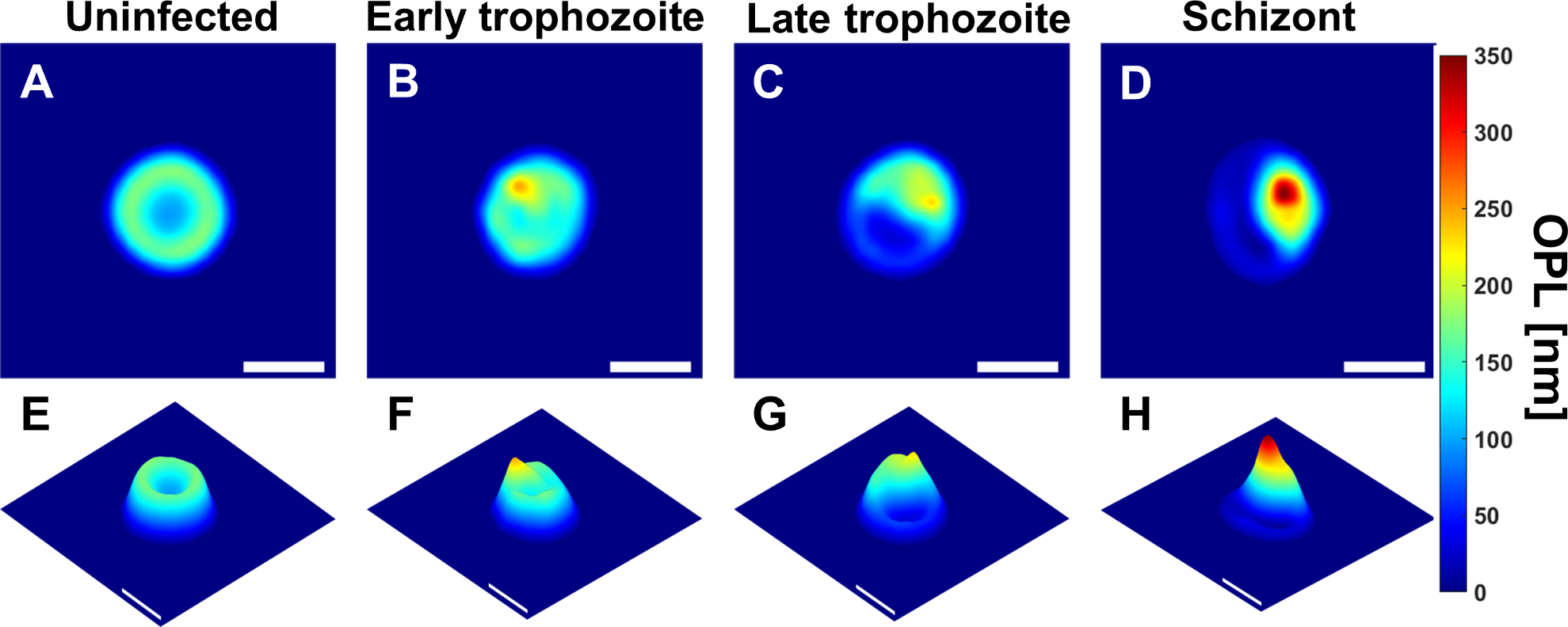 Bright-field microscopy images: (A) uninfected RBC (B-D) RBCs with malaria parasite in early trophozoite, late trophozoite, and schizont stages respectively (scale bars = 5μm). Source: Park et al (2016) https://doi.org/10.1371/journal.pone.0163045