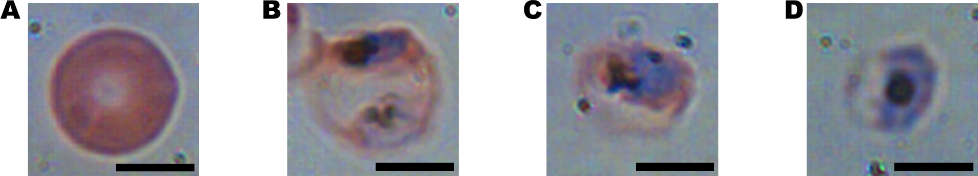 Uninfected RBC and RBCs infected by P. falciparum in early trophozoite, late trophozoite, and schizont stages represented respectively as: (A-D) OPL maps, (E-F) OPL maps from different viewpoint (scale bars = 5μm). Source: Park et al (2016) https://doi.org/10.1371/journal.pone.0163045